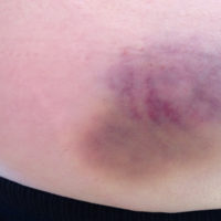 Blauwe plekken