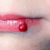 Granuloma pyogenicum-Titel