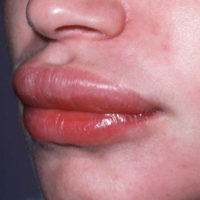 Hereditair Angiooedeem