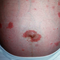 Herpes Gestationes buik