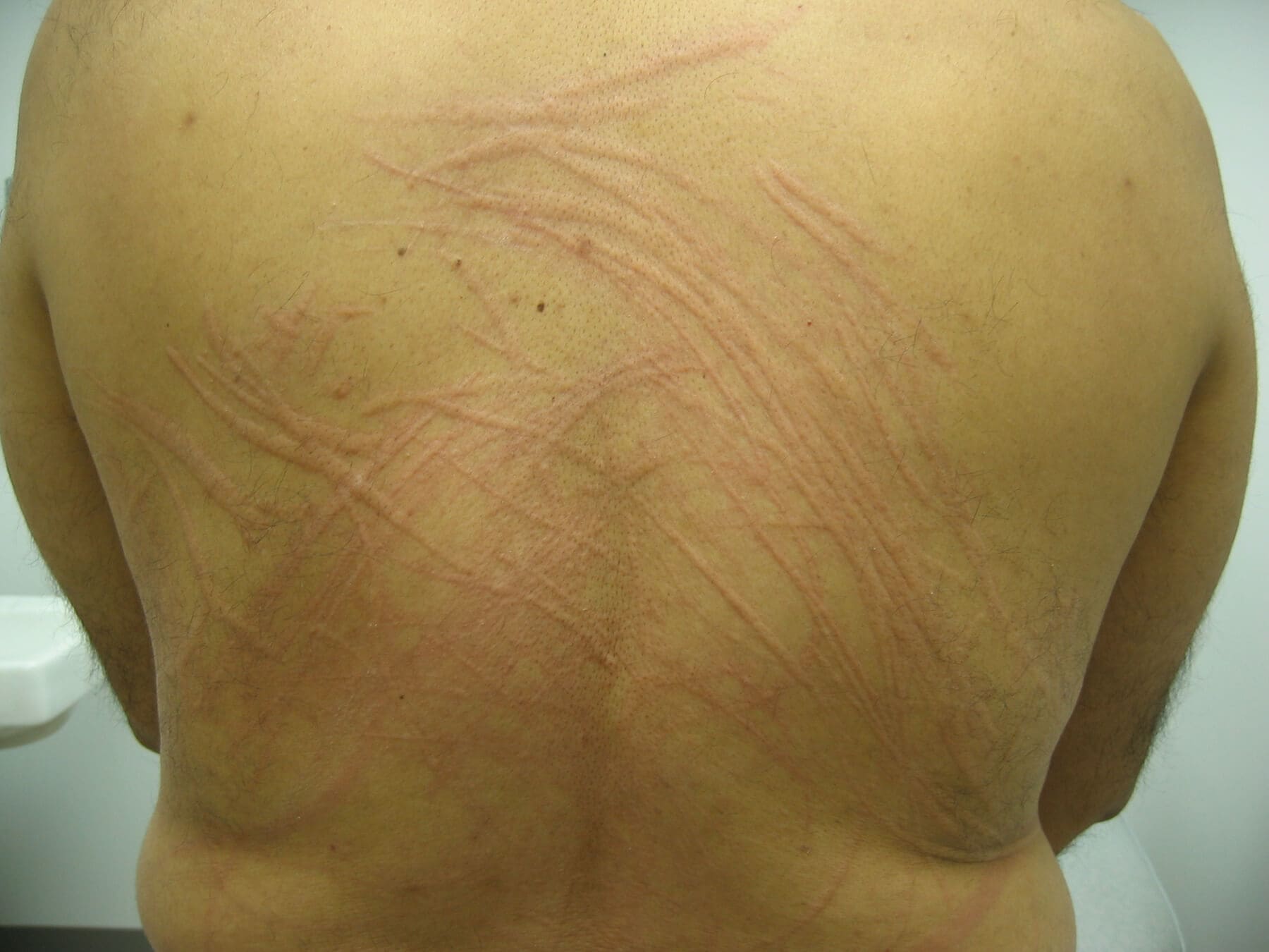 What is a Stress Rash? (with pictures) - wiseGEEK