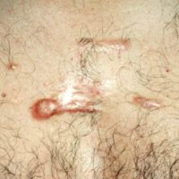 Keloid