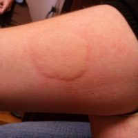 Koude Urticaria