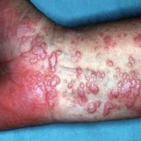 Lichen-planus-Titel