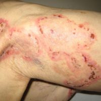 Lineaire IgA dermatose-Titel