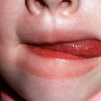 Lipliksyndroom -Titel