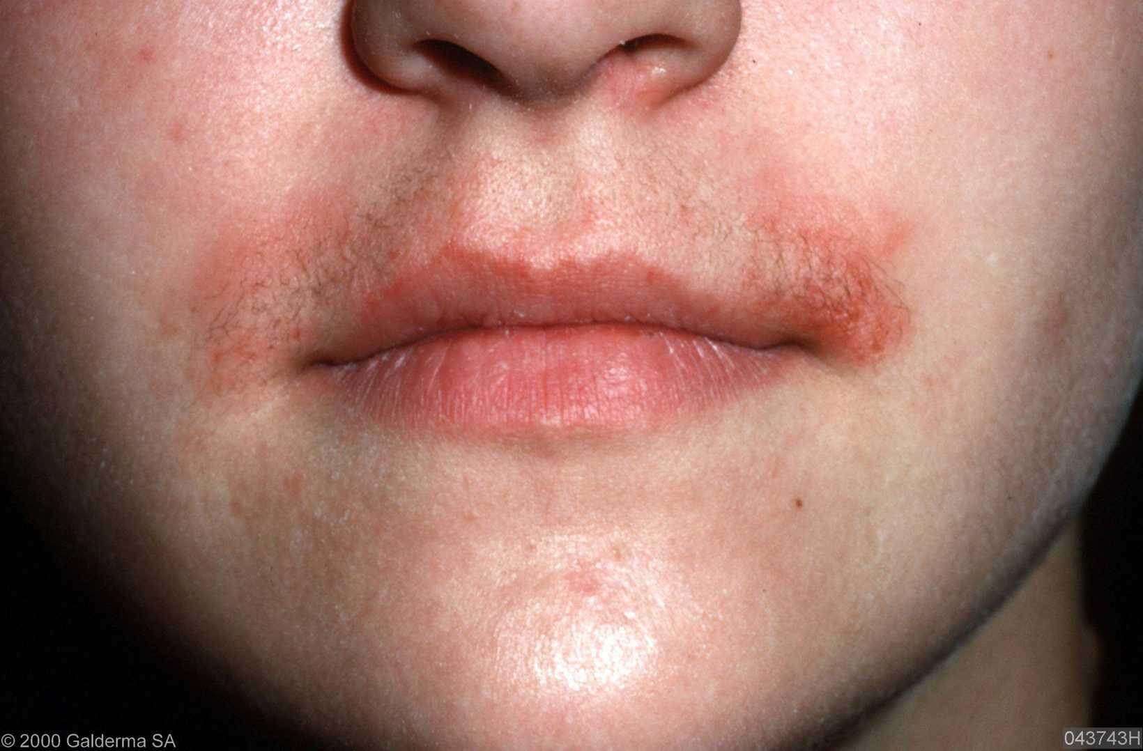 Dyshidrotisch Eczeem Gezicht HUID Germaanse Geneeskunde