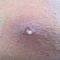 Myiasis Titel