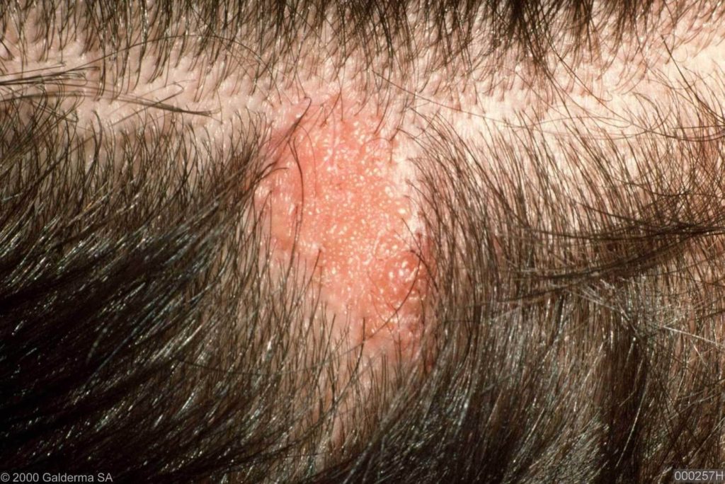 Linear nevus sebaceous syndrome | Genetic and Rare ...