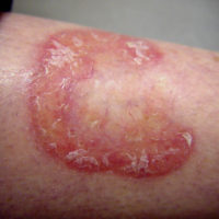 Necrobiosis Lipoidica