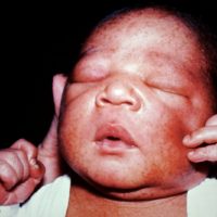 Neonatale Pustuleuze melanose