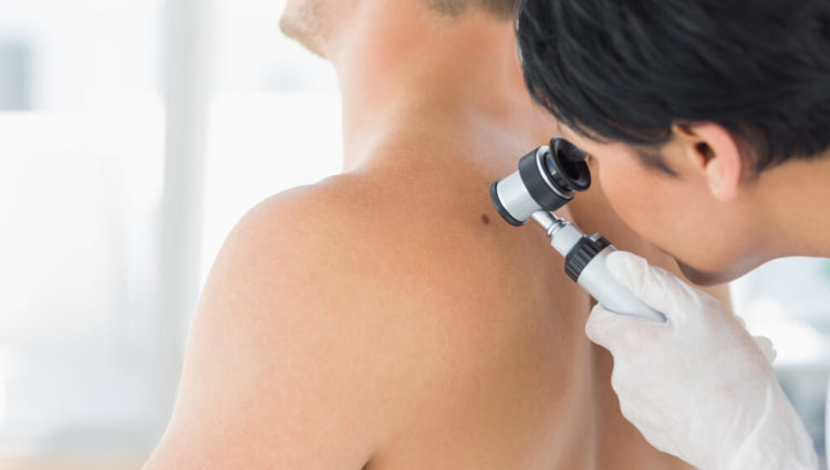 Dunnere melanomen vaker ontdekt door ervaren dermatologen