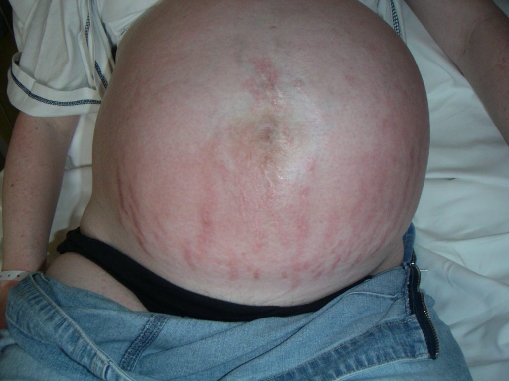 Pruritic urticarial papules and plaques of pregnancy ...