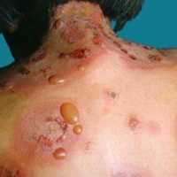Parapemphigus-Titel