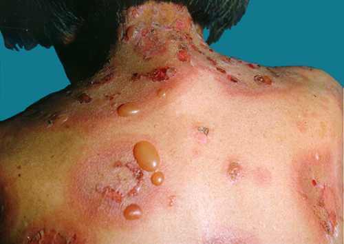 Bullous Pemphigoid Causes, Treatment & Symptoms