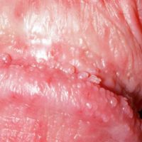 Pearly Penile Papules-Titel