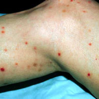 Pityriasis Lichenoides Titel