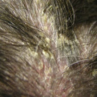 Pityriasis amiantacea