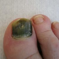 Pseudomonas nagel-Titel