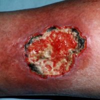 Pyoderma gangrenosum-titel