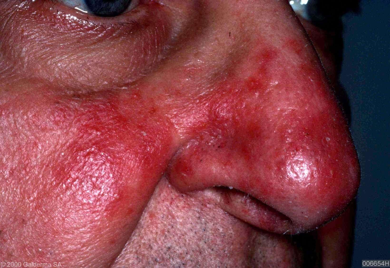 The Link Between Rosacea and Alcohol - WebMD