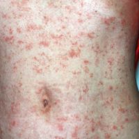 Schurft of scabies op de buik