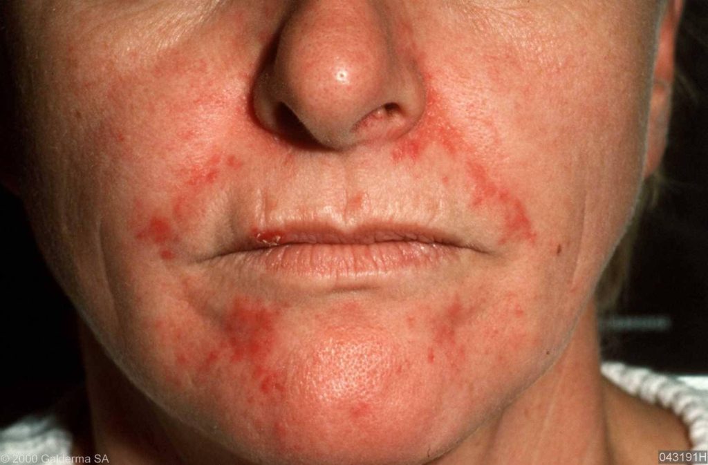 Afbeeldingsresultaat voor ï»¿SeborrhoÃ¯sch dermatitis