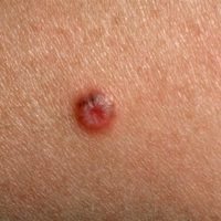 Spitz Nevus Titel
