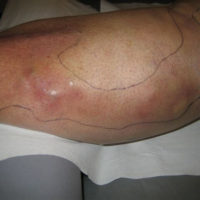 Tromboflebitis