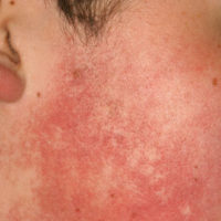 Ulerythema wang