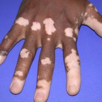 Vitiligo-hand-titel
