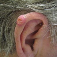 chondrodermatitis-Titel