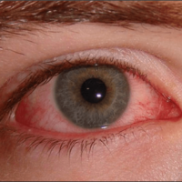 Conjunctivitis