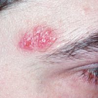 granuloma faciale