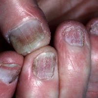 nagelpsoriasis-2