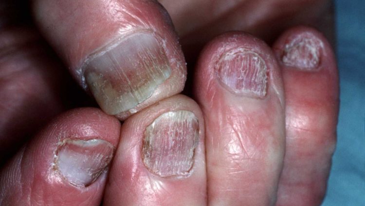 Psoriasis van de nagels