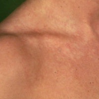 nevus-anemicus