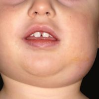 Mumps