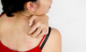 Allergie voor kleding