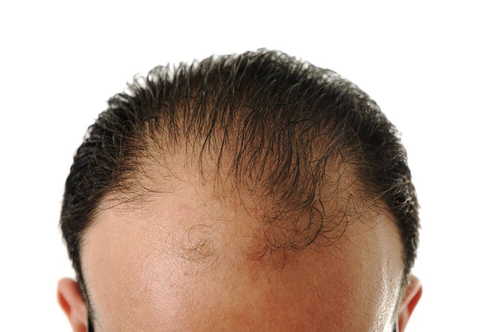 spier Stoffelijk overschot efficiëntie Alopecia androgenetica - Huidarts.com