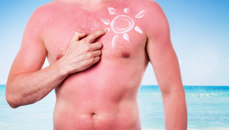 Sunburn tattoo: rage of ravage ?