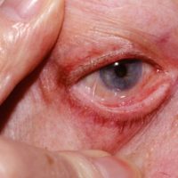 Slijmvliespemphigoid-Titel