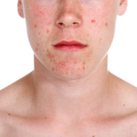 acne mild