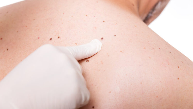 Micromelanomen, “nieuw” gevaar in de huid ?