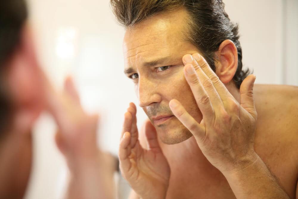 Melasma komt ook bij mannen voor