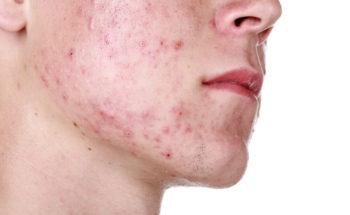 acne conglobata