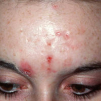 acne voorhoofd