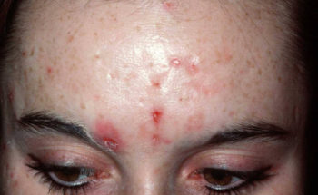 acne voorhoofd
