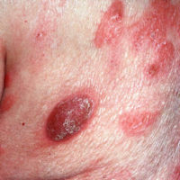 Mycosis Fungoides-Titel