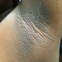 Acanthosis nigricans Titel